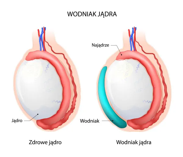 nowotw&oacute;r jądra żylaki powr&oacute;zka nasiennego wodniak jądra
