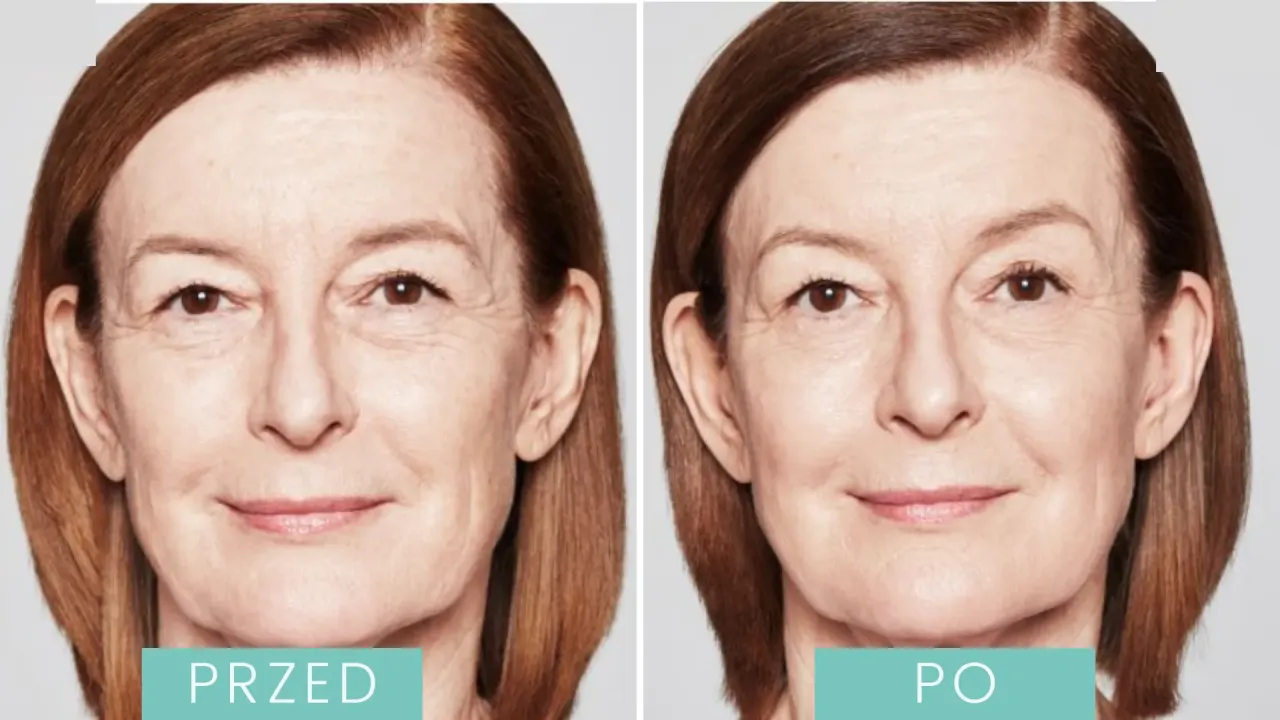 cennik medycyna estetyczna kwas hialuronowy polimlekowy