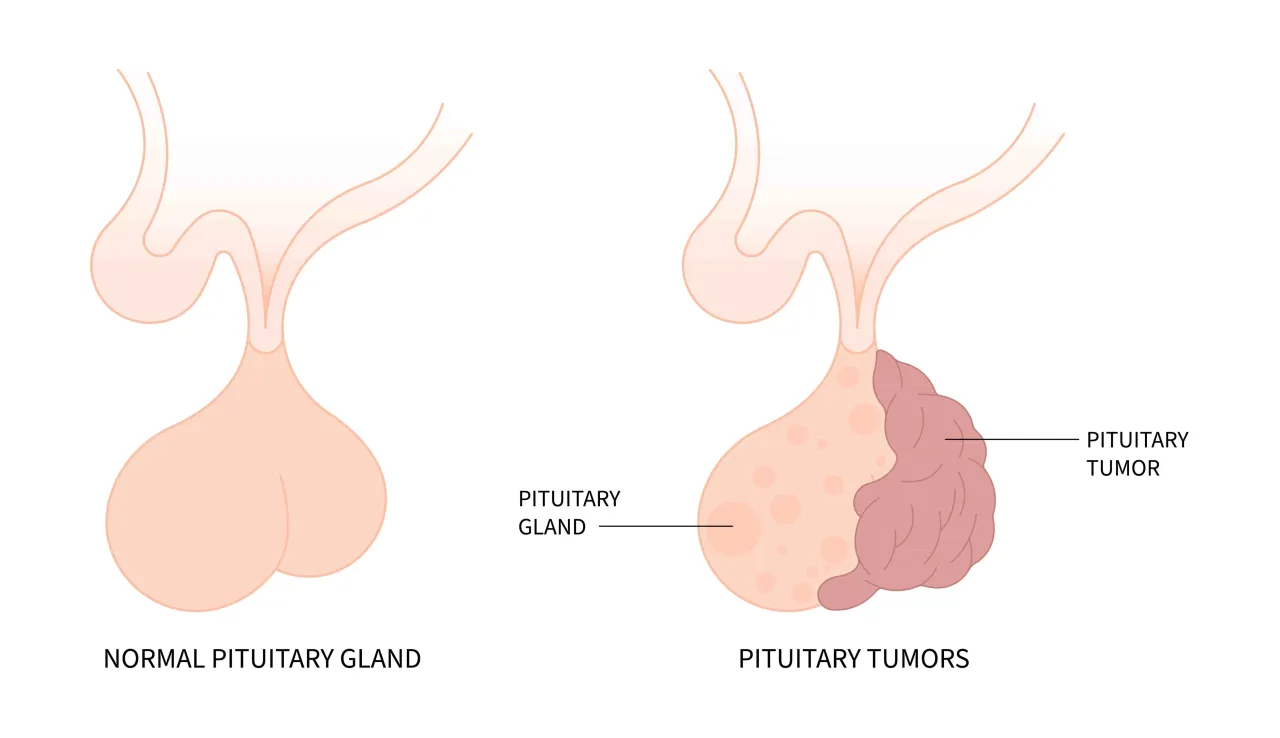 Leczenie prolactinoma schemat