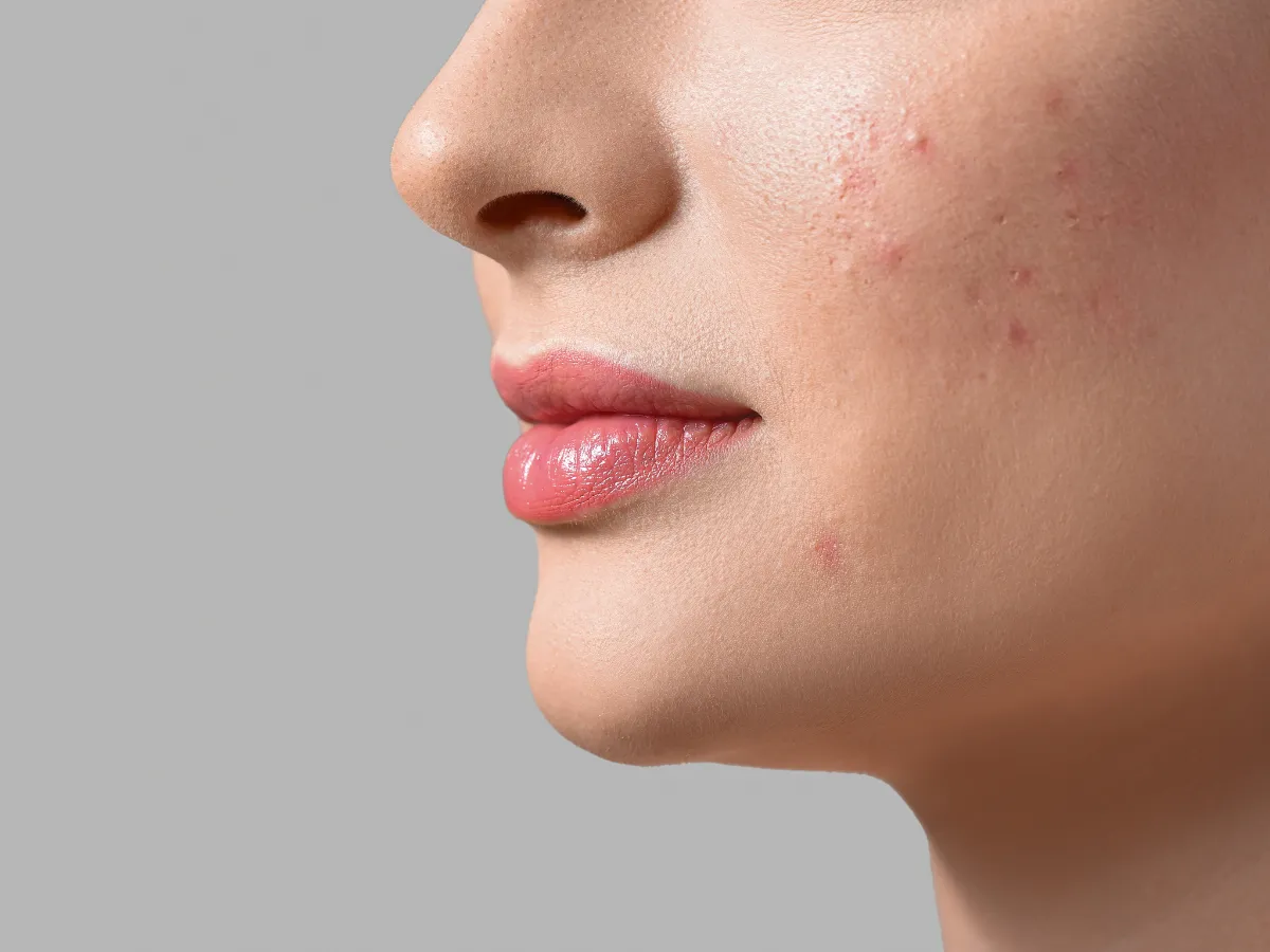 kiedy do dermatologa z pryszczem