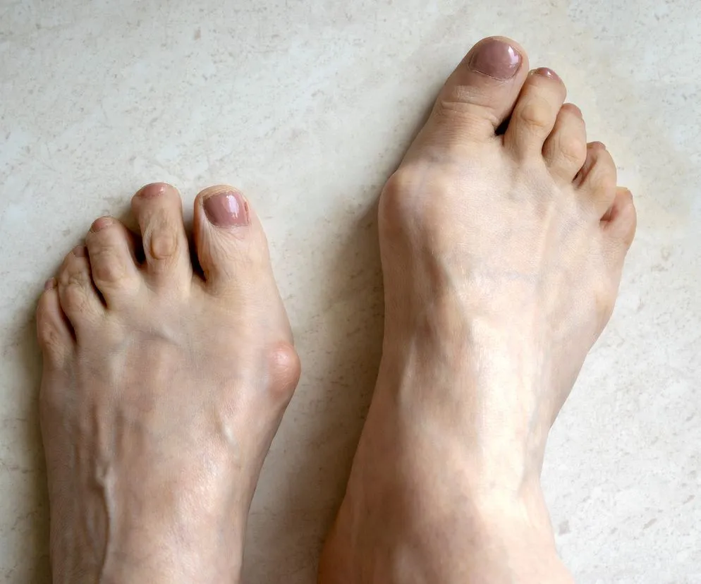 haluksy pierwsze objawy stopa