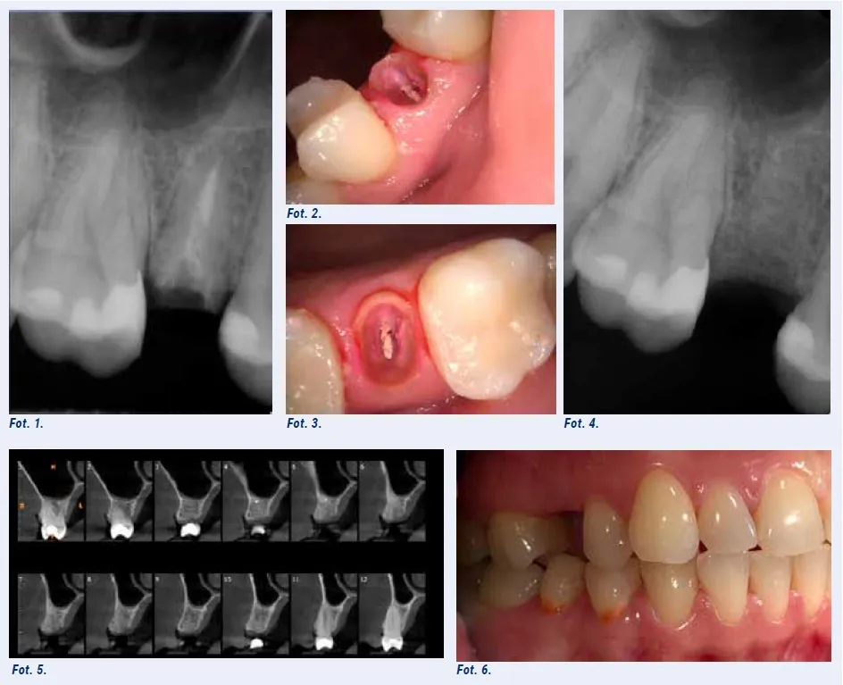 różnica między ekstrakcją zwykłą a chirurgiczną zęba
