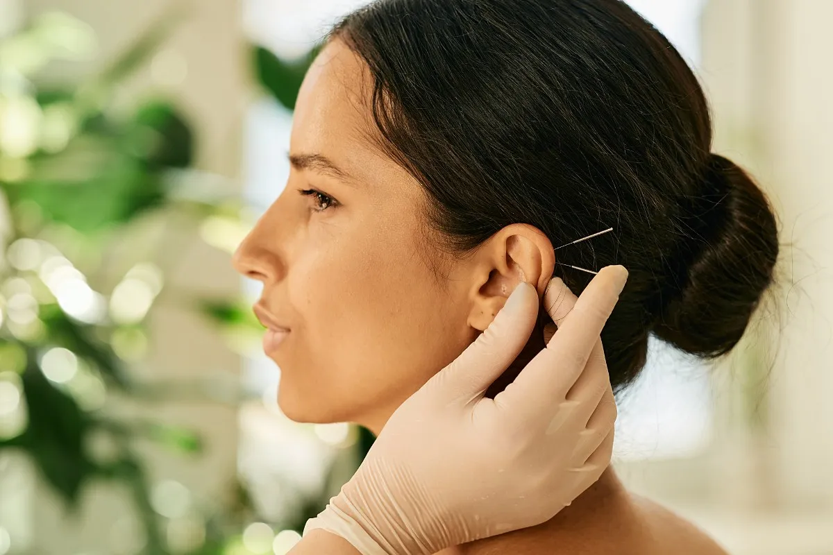 Akupunktura na migrenę igły punkty