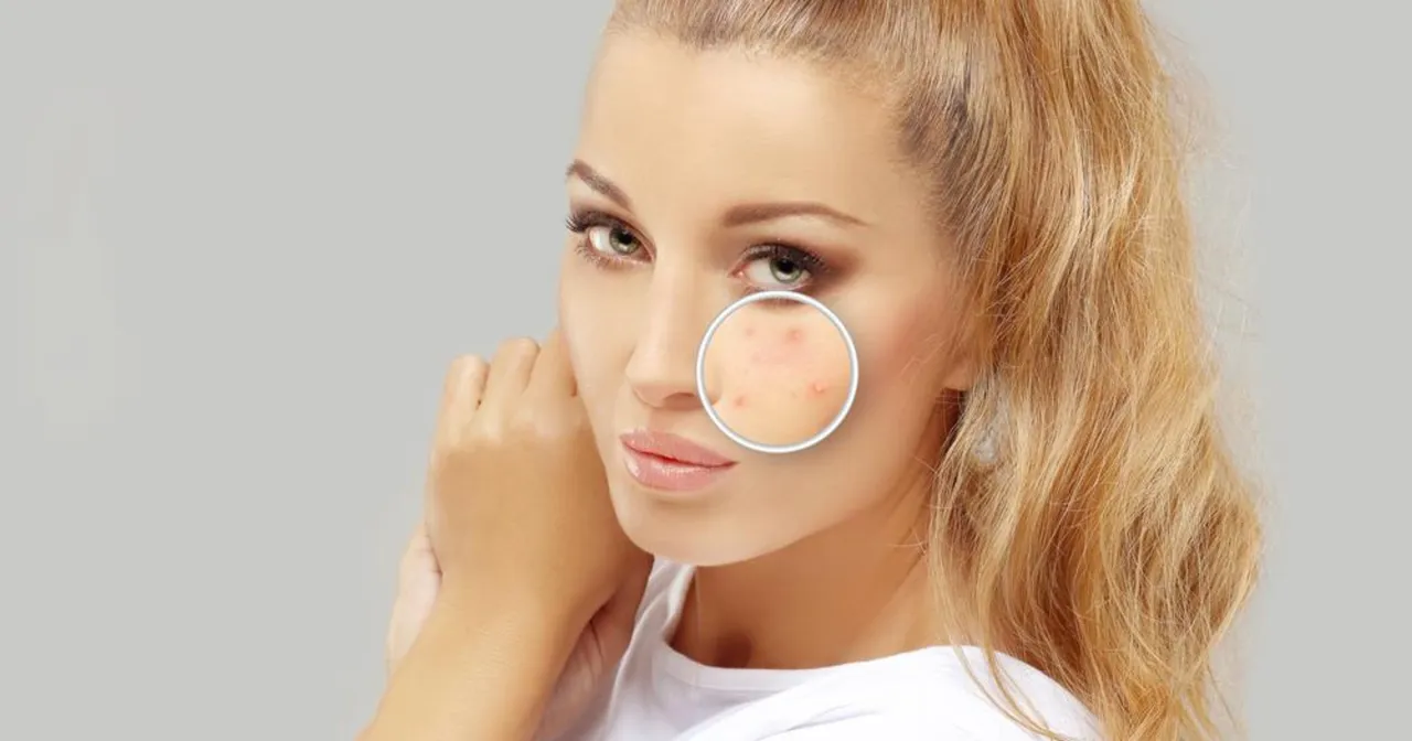 Mechanizm powstawania pryszczy