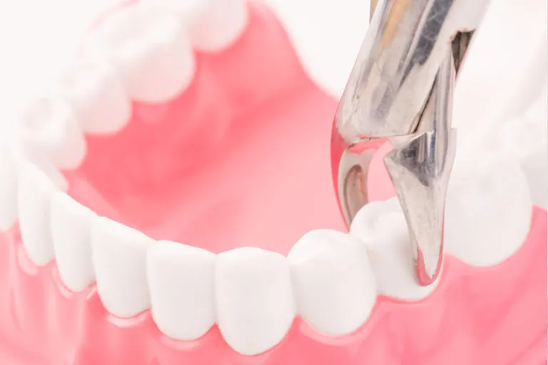 Zdjęcie Co dentysta wkłada do zęba po usunięciu? Wyjaśniamy proces i zalecenia po zabiegu