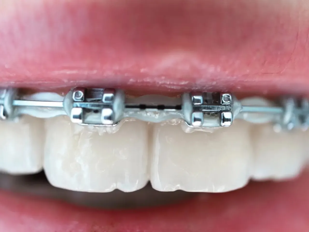 porównanie aparatów ortodontycznych stałych
