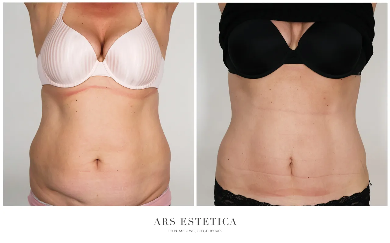 por&oacute;wnanie metod liposukcji grafika