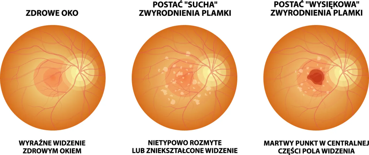 AMD wysiękowe oko siatk&oacute;wka