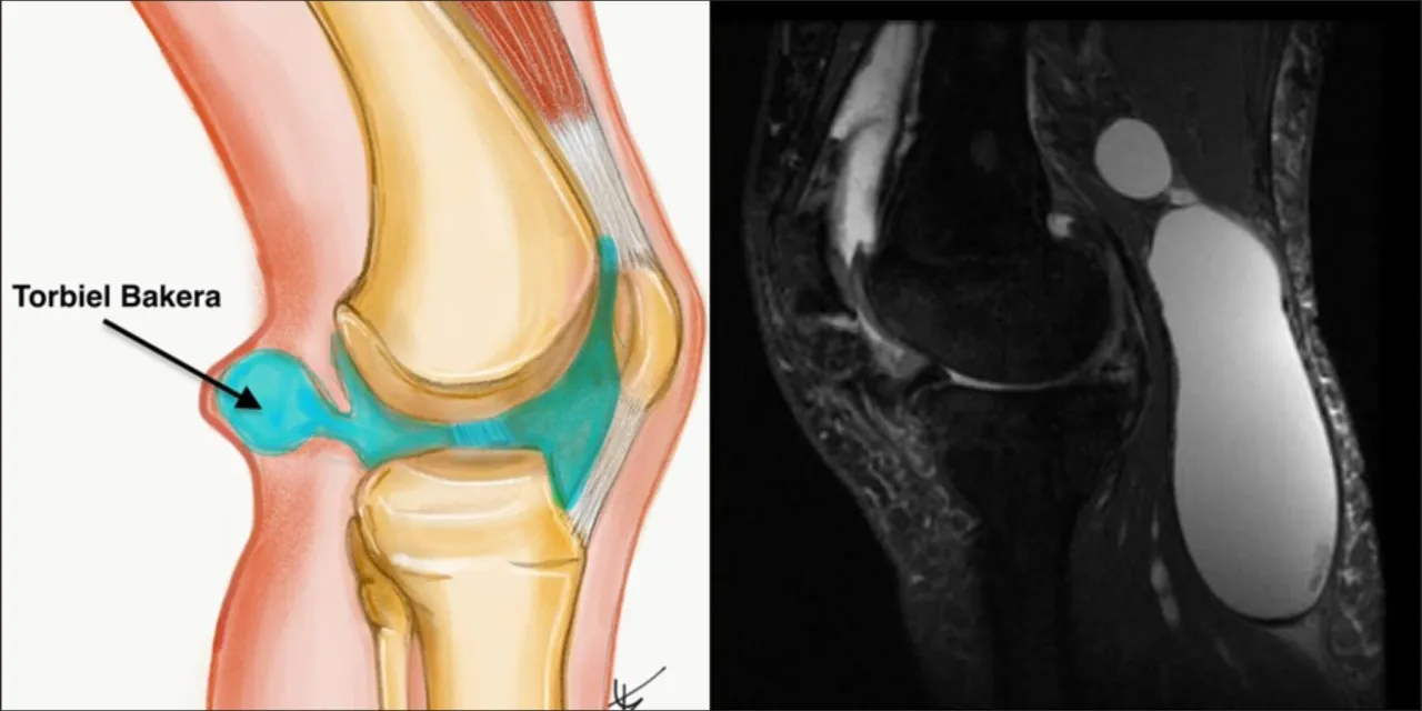 Torbiel Bakera anatomia kolana