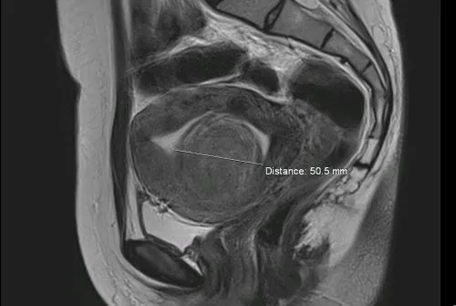 Rezonans magnetyczny miednicy mięśniak
