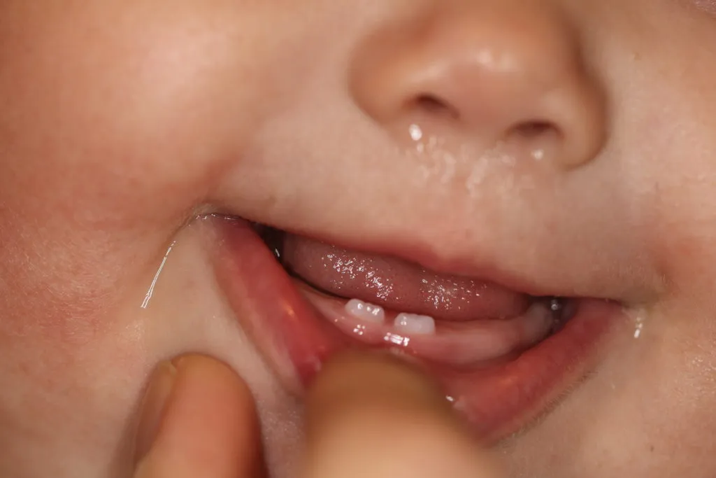 dziąsła przy ząbkowaniu wygląd etapy