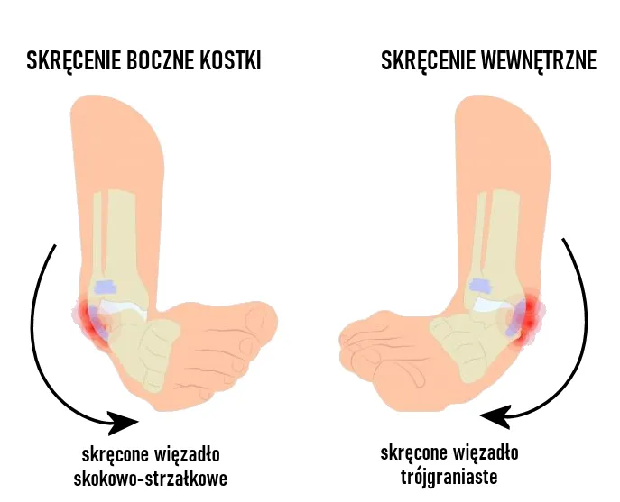 Różnice między skręceniem a złamaniem kostki infografika