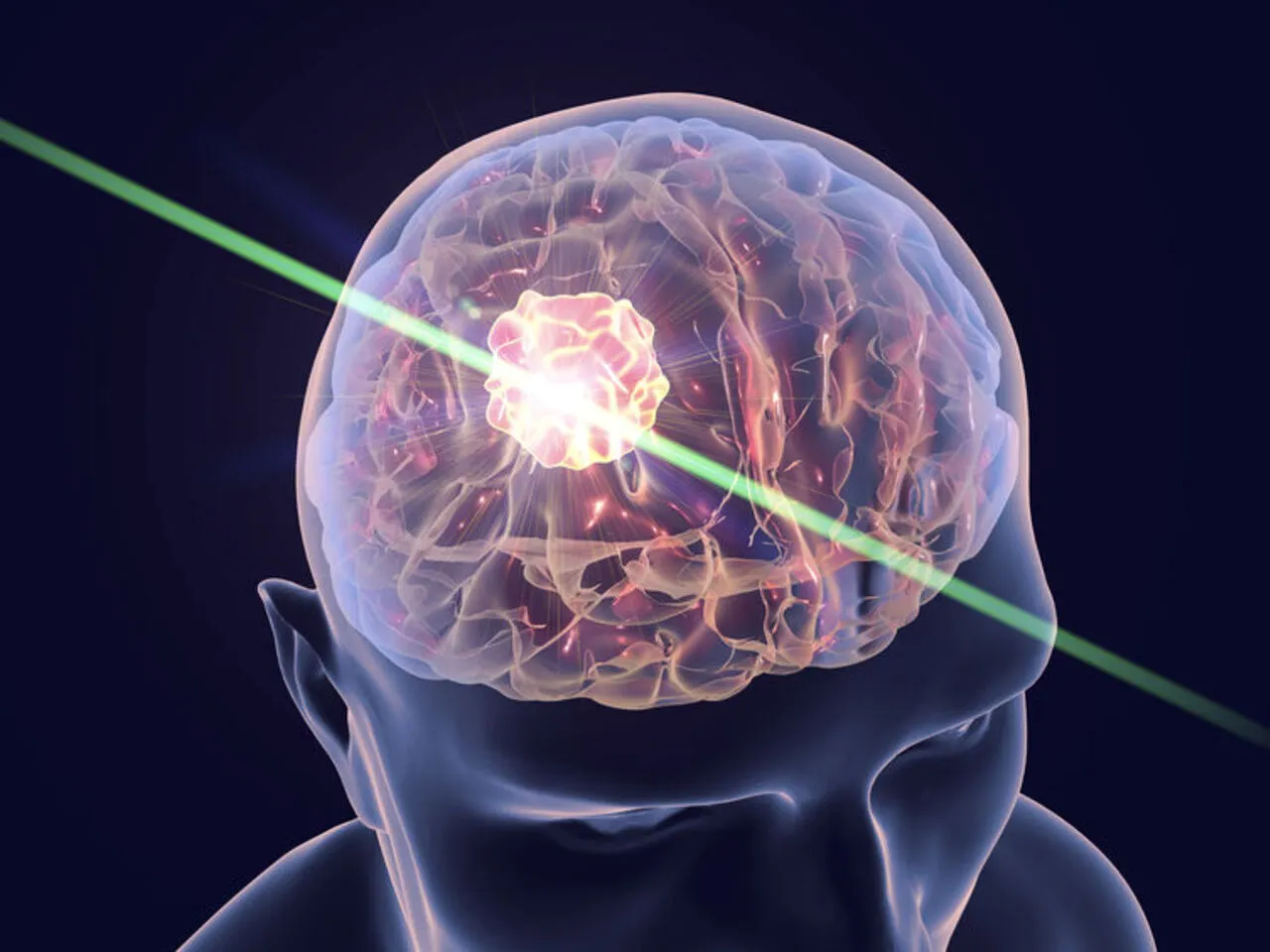 Lokalizacja glejaka a objawy