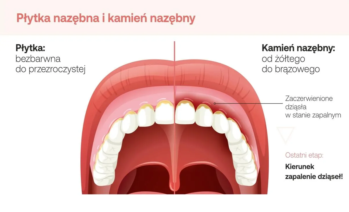 Przyczyny zapalenia dziąseł płytka nazębna kamień