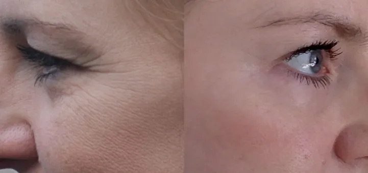 efekty stosowania retinolu i kwasu hialuronowego przed po