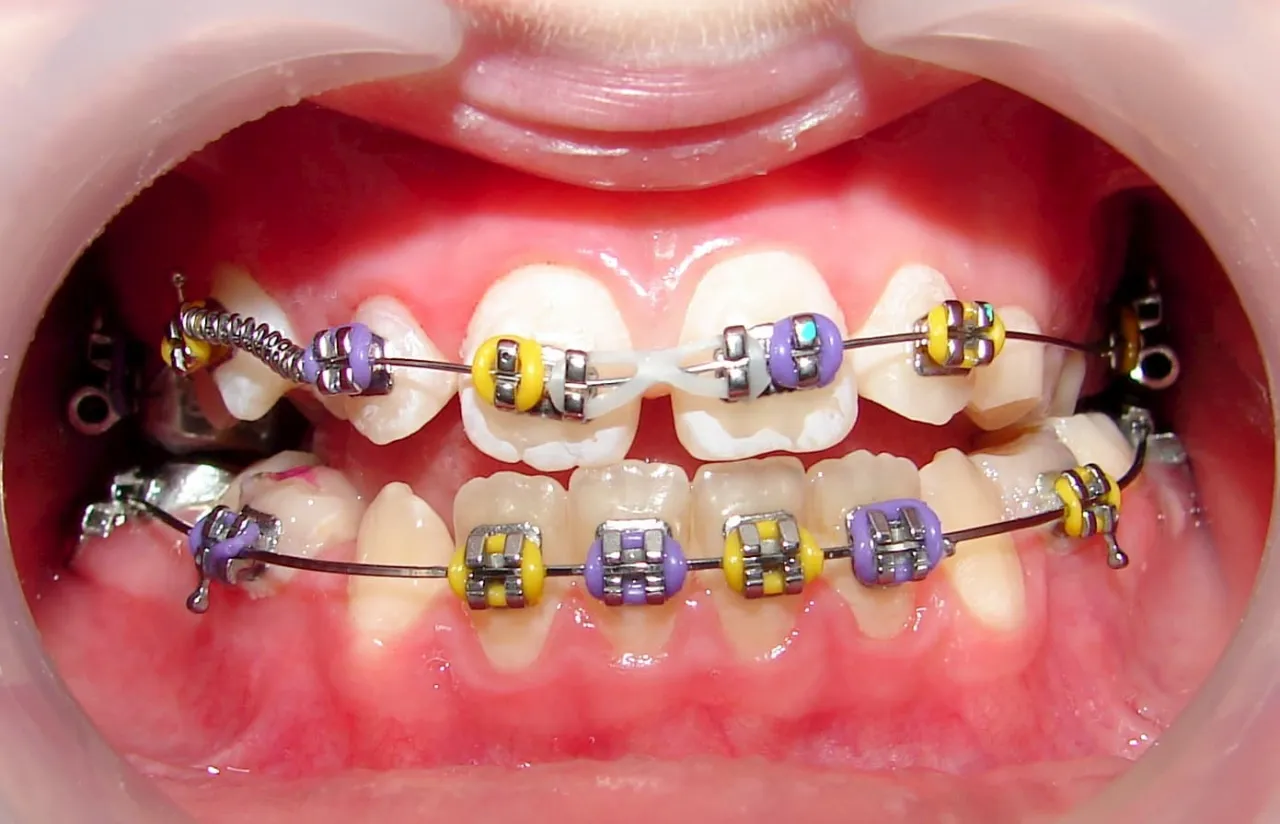 aparat ortodontyczny częściowy zastosowanie