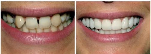 Most protetyczny przed i po założeniu, efekty leczenia