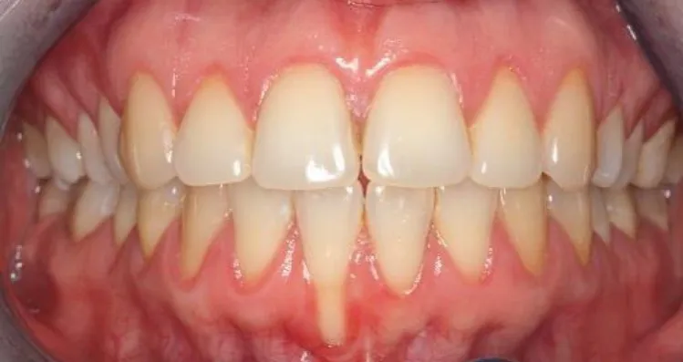 Rodzaje recesji dziąseł zdjęcia