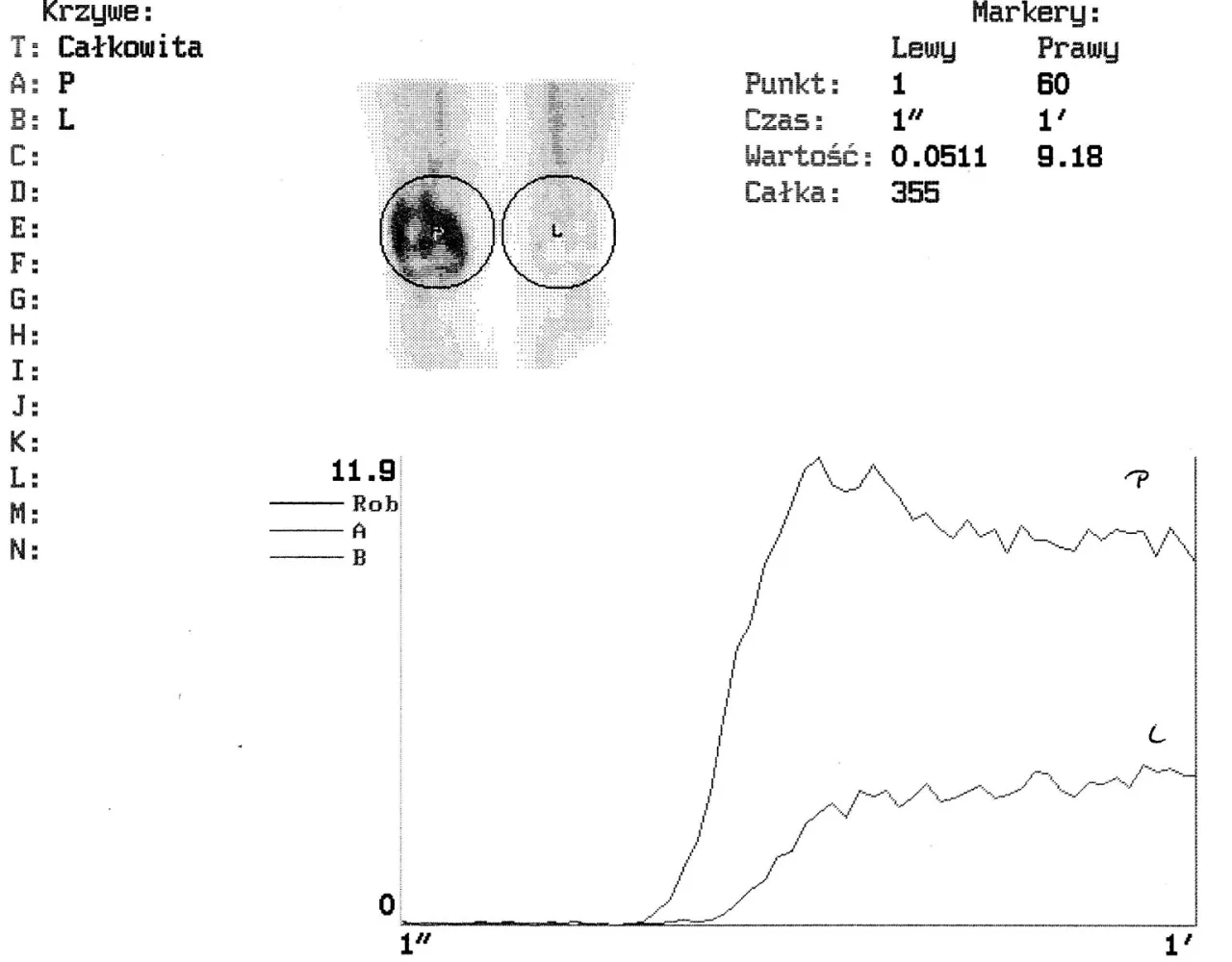 wynik badania PET-CT 