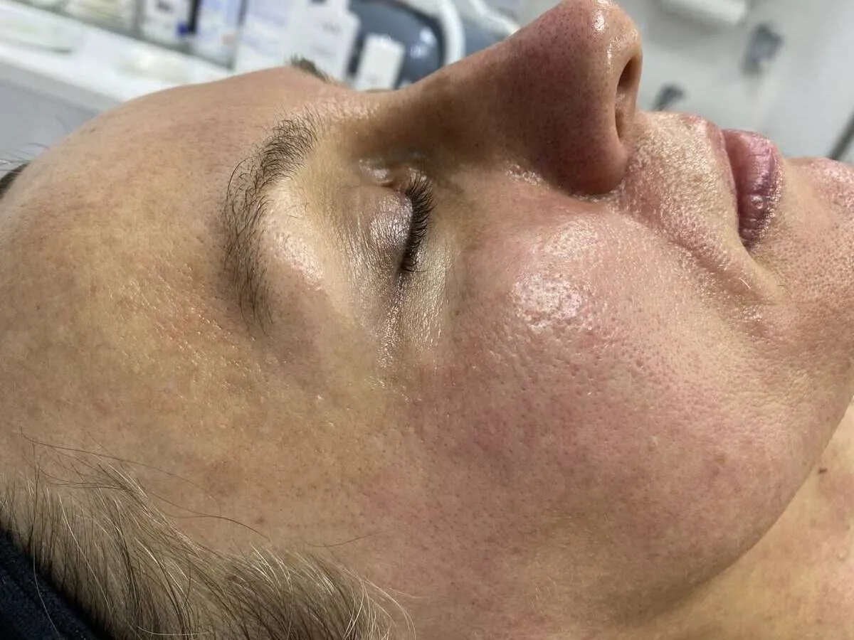 Pielęgnacja po RF mikroigłowej