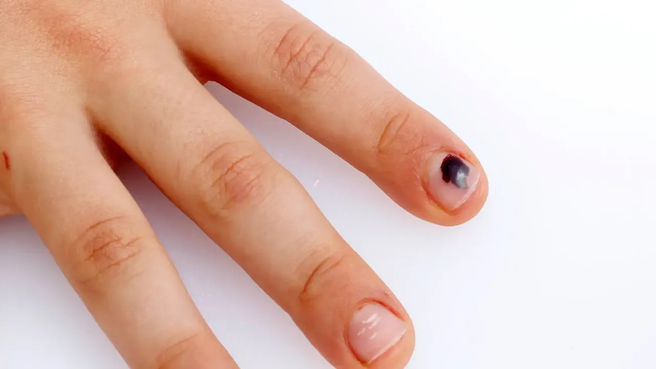 Czerniak paznokcia melanonychia