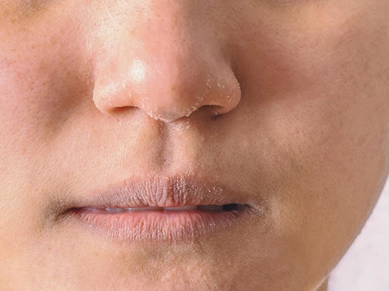 Gesichtshaut pellt sich ab Ursachen