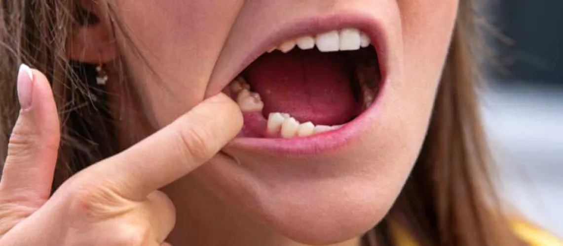 Skrzep krwi po ekstrakcji zęba