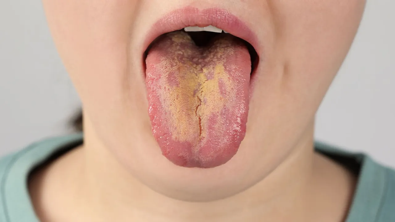 czynniki ryzyka kandydozy jamy ustnej