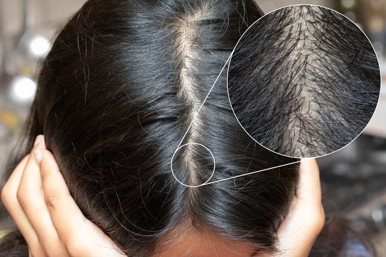 kobieta z objawami hirsutyzmu lub łysienia androgenowego