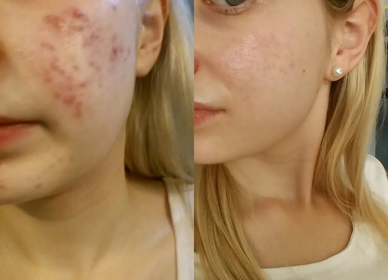 suchość skóry izotek