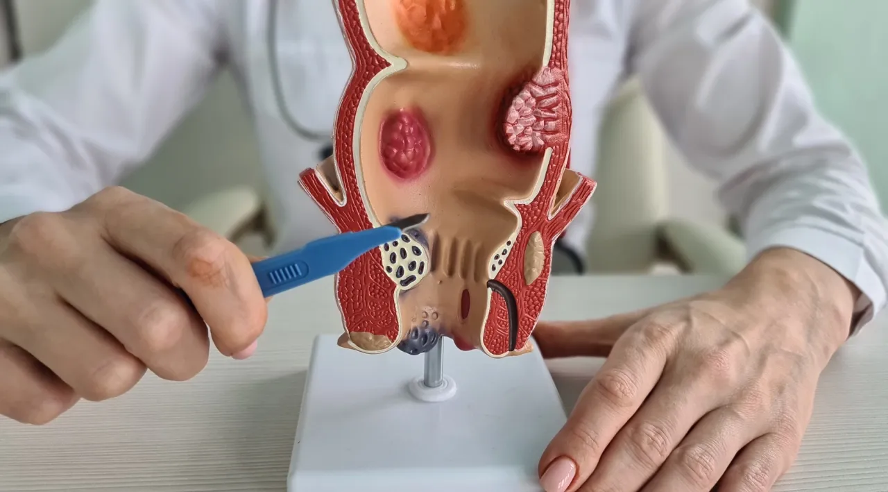 Metody leczenia hemoroid&oacute;w zabiegi
