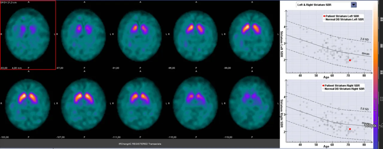 DaT-Scan Gehirn Parkinson
