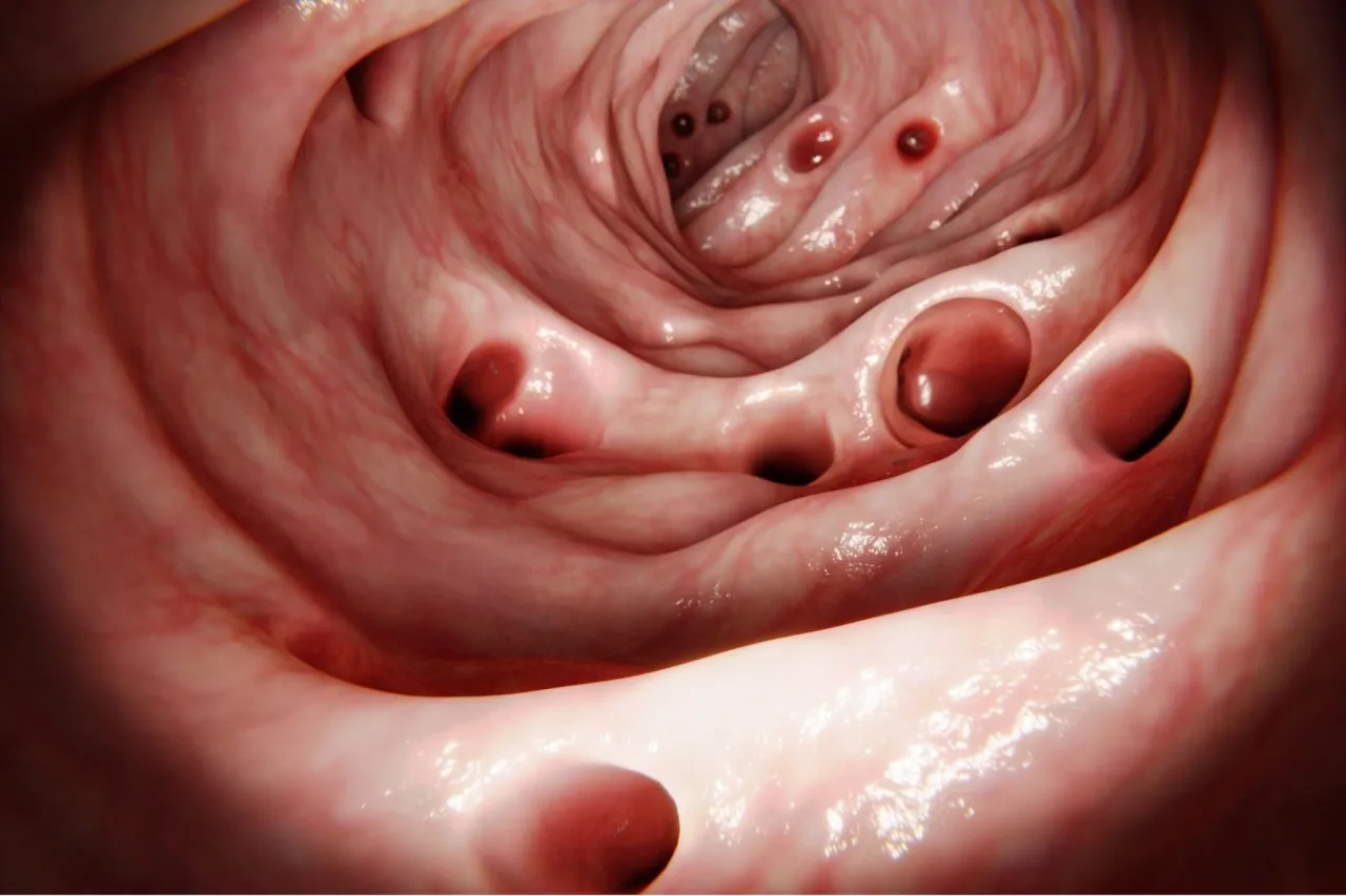 Uchyłki jelita grubego schemat