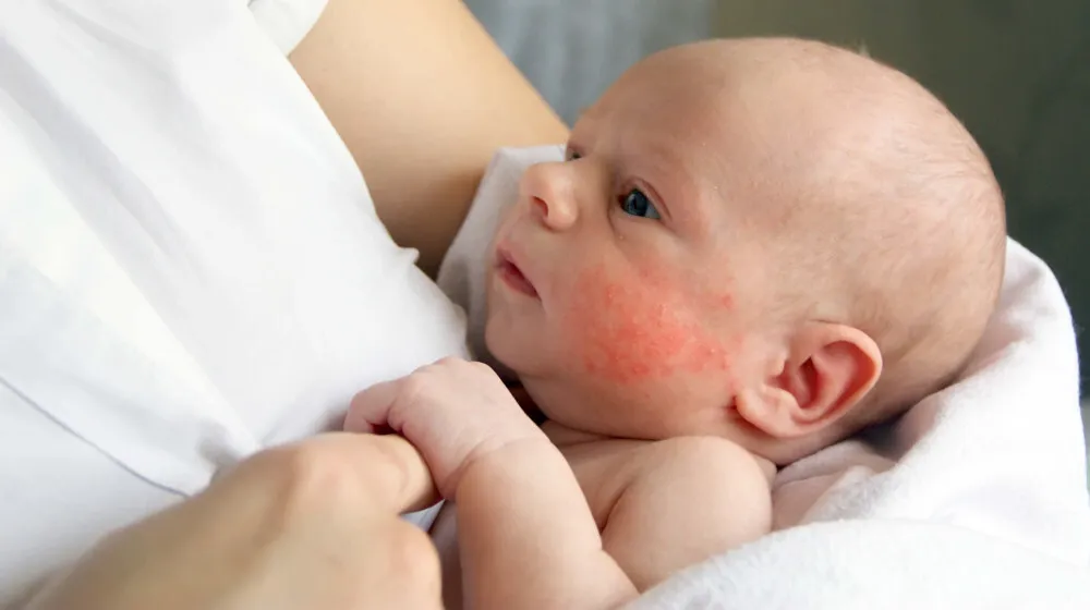 Zdjęcie Czy czekolada uczula niemowlaka? Objawy i ryzyko alergii pokarmowej