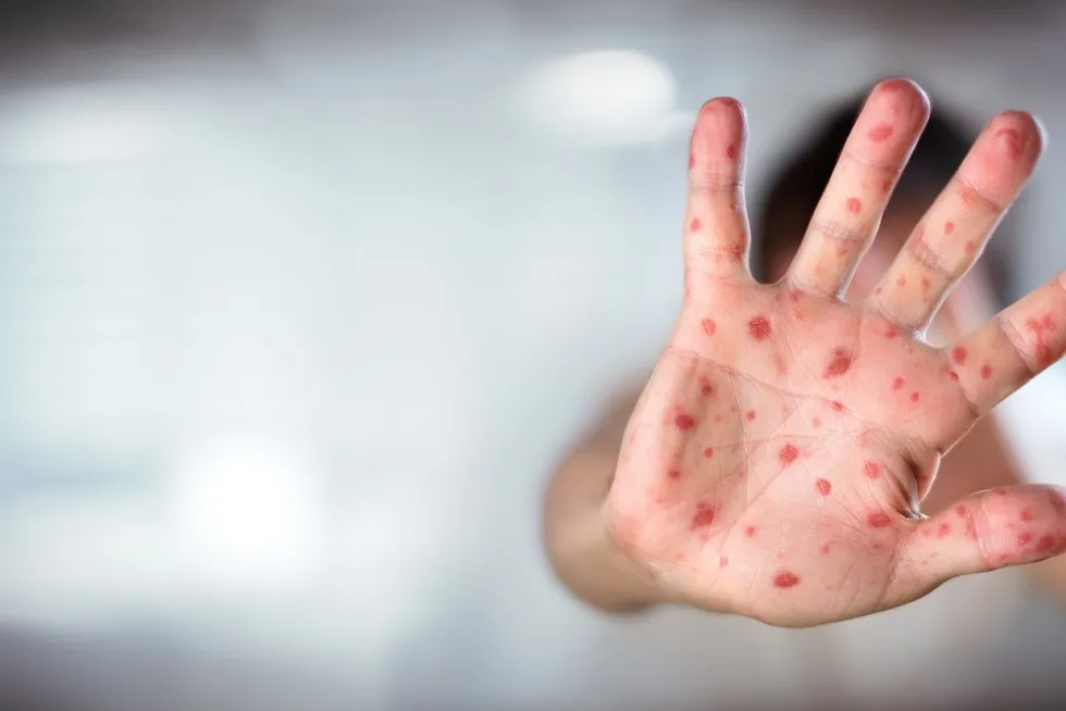 Zdjęcie Czy po bostonce schodzą paznokcie? Zaskakujące skutki uboczne!