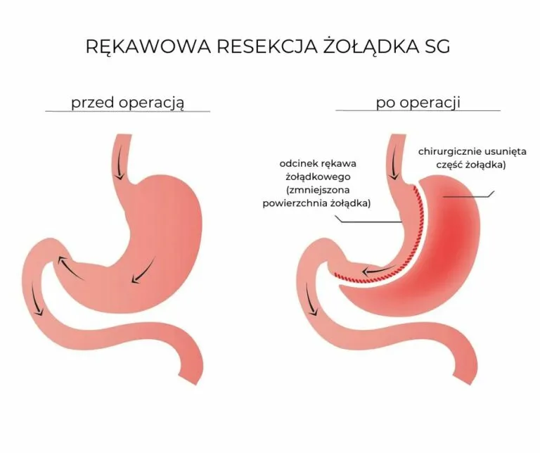 Zdjęcie Spożywanie alkoholu po zmniejszeniu żołądka: Co musisz wiedzieć