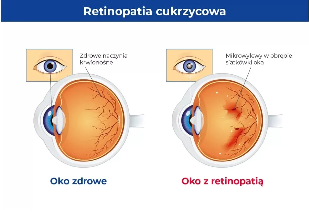 Wpływ cukrzycy na naczynia krwionośne oka schemat