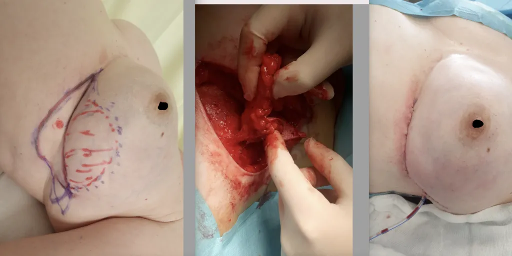 piersi po lumpektomii zdjęcia, blizna po operacji oszczędzającej, pierś po radioterapii wygląd