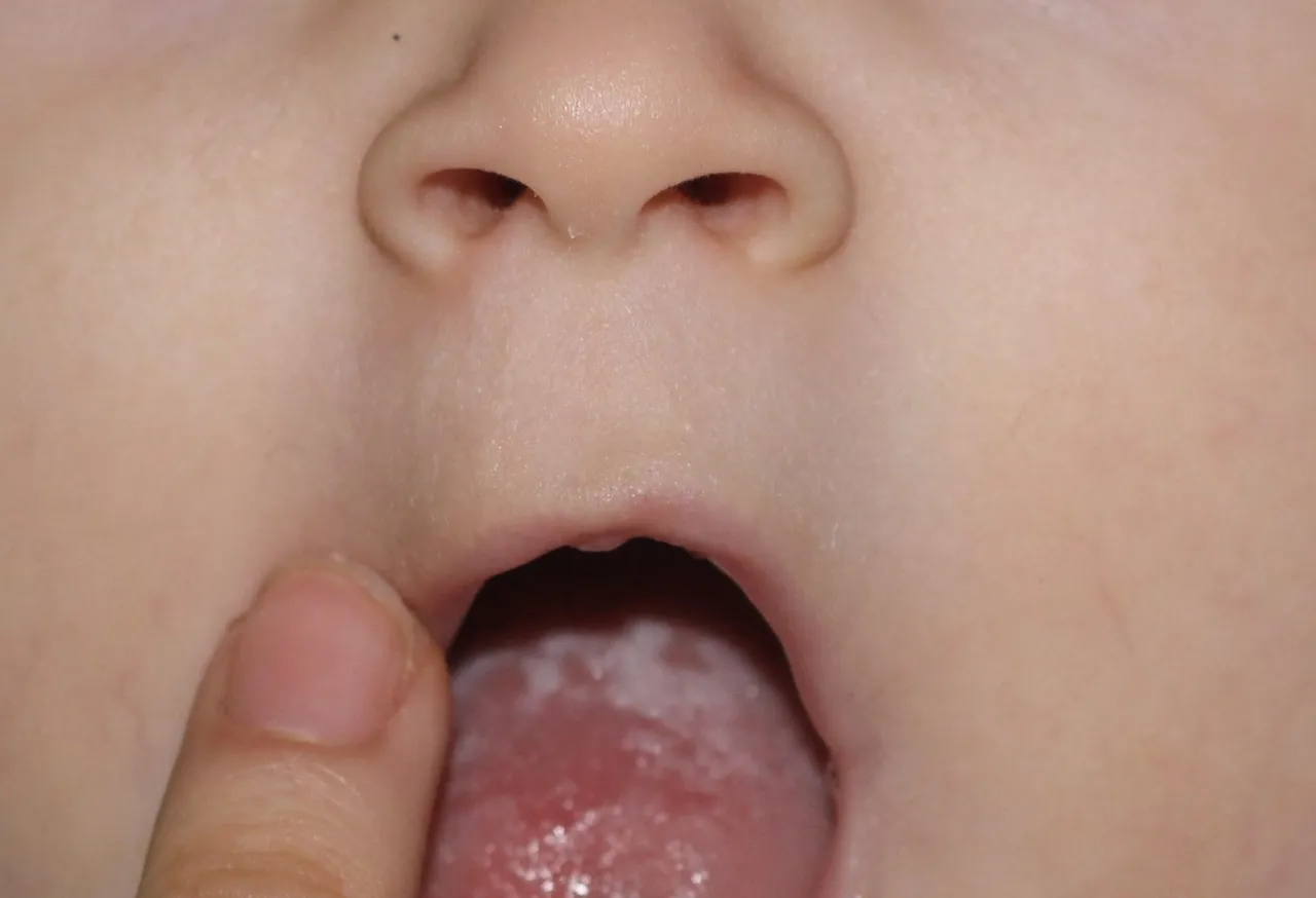 pleśniawki u niemowlaka, nalot mleczny u dziecka