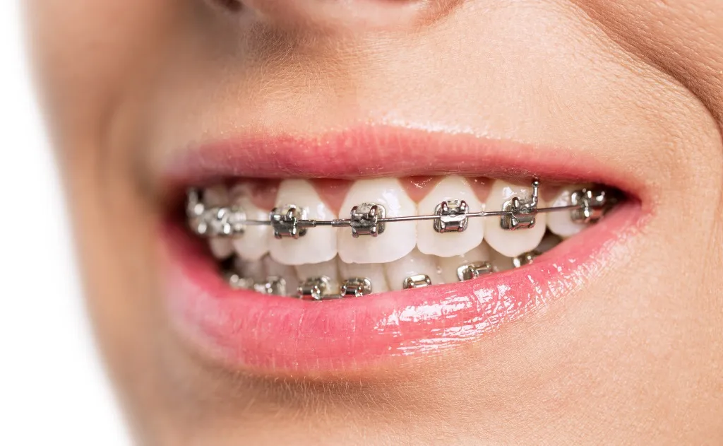 aparat ortodontyczny na zębach