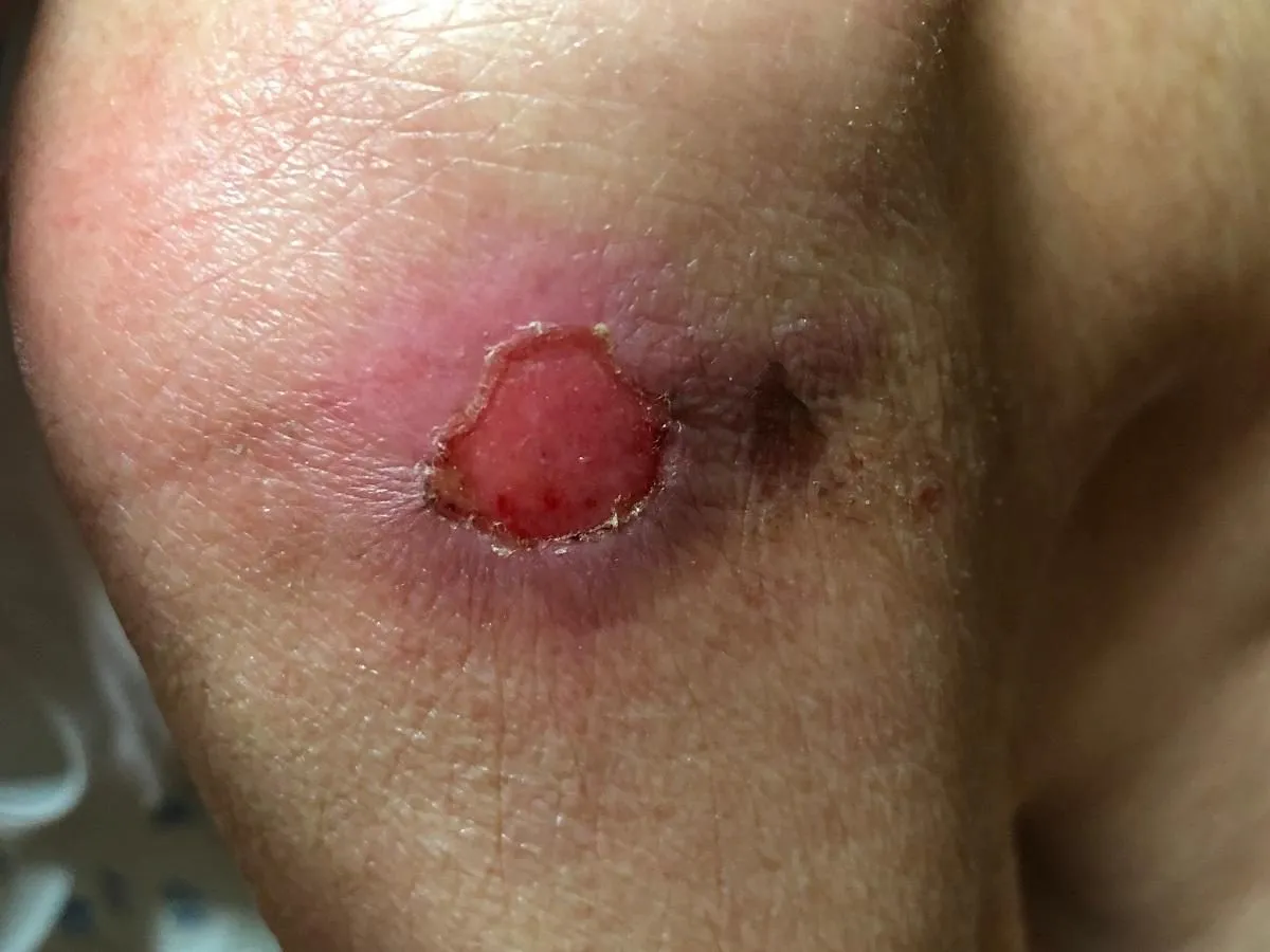 odleżyny powikłania sepsa kości