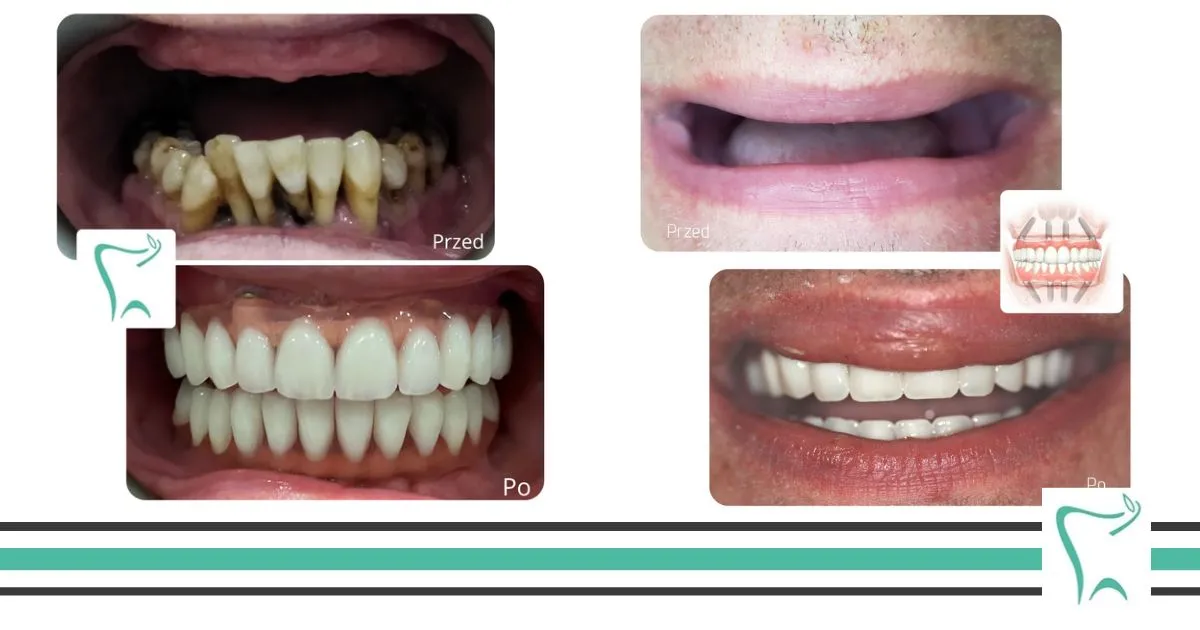 przed i po implantach zębowych all on 4