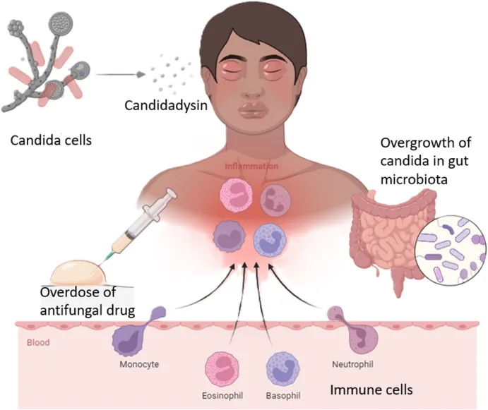 Candida Die-Off Symptome &Uuml;bersicht