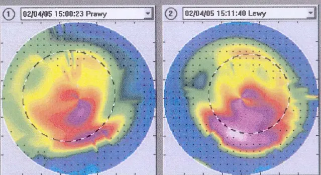 przekr&oacute;j oka z soczewką niedotlenienie rog&oacute;wki