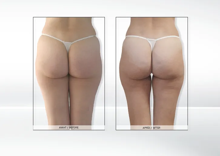 zabiegi redukujące bryczesy kriolipoliza endermologia