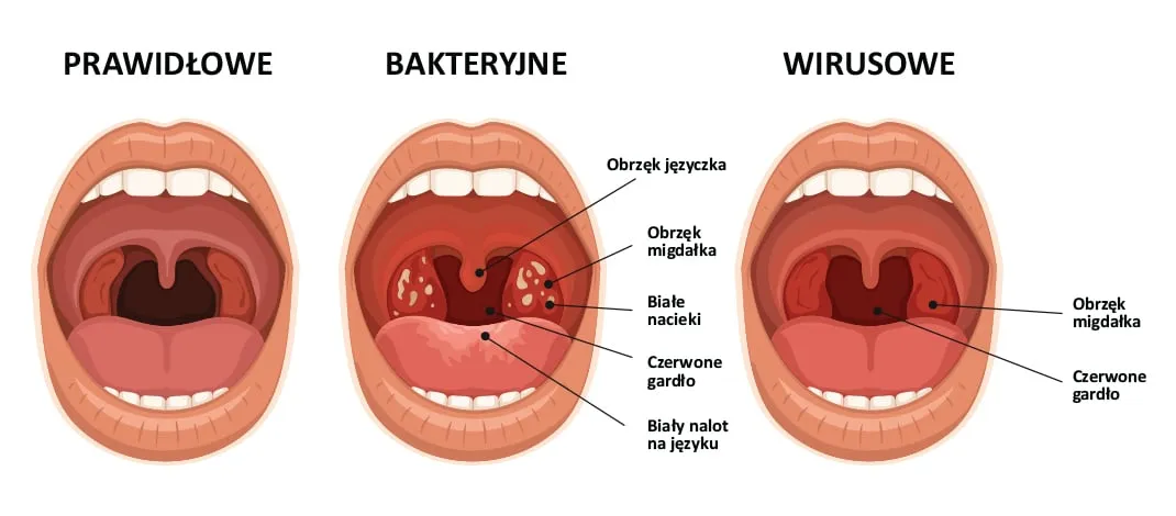 Jak wygląda chore gardło wirusowe i bakteryjne