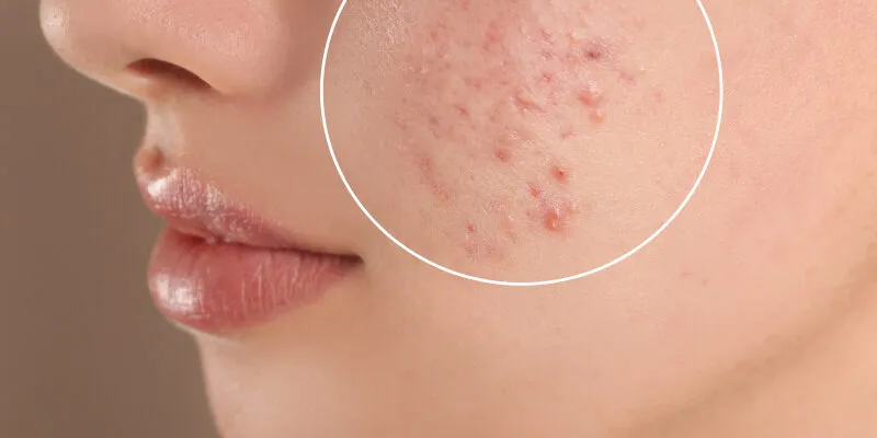 Profesjonalne zabiegi na blizny potrądzikowe