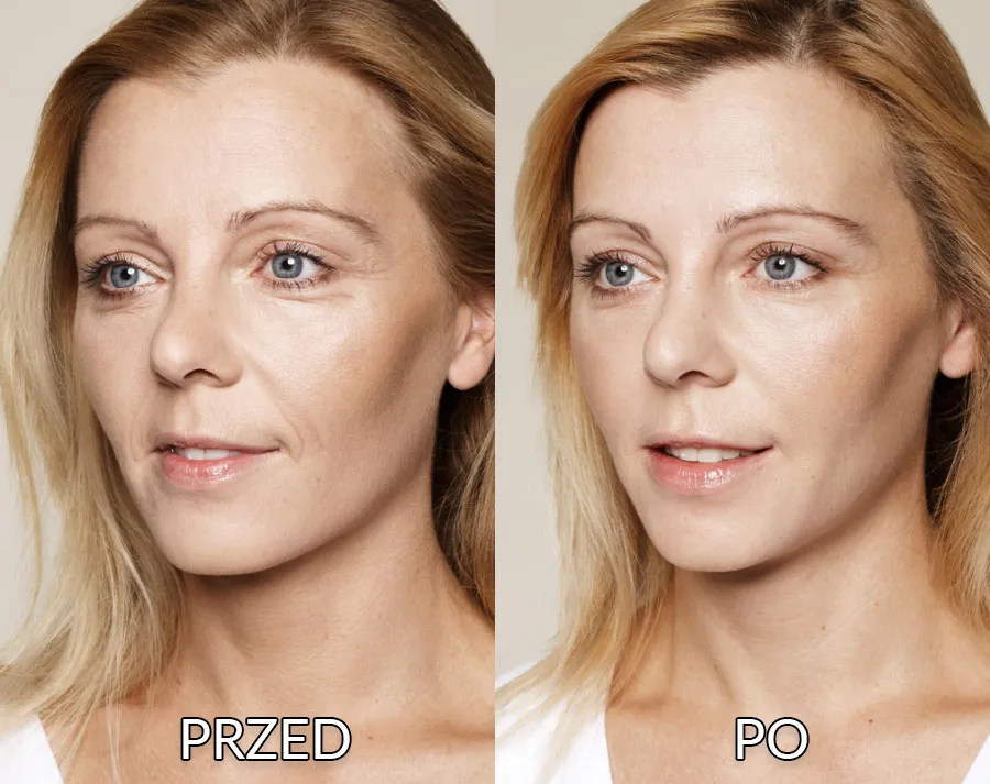 kobieta przed i po kwas hialuronowy sk&oacute;ra nawilżenie