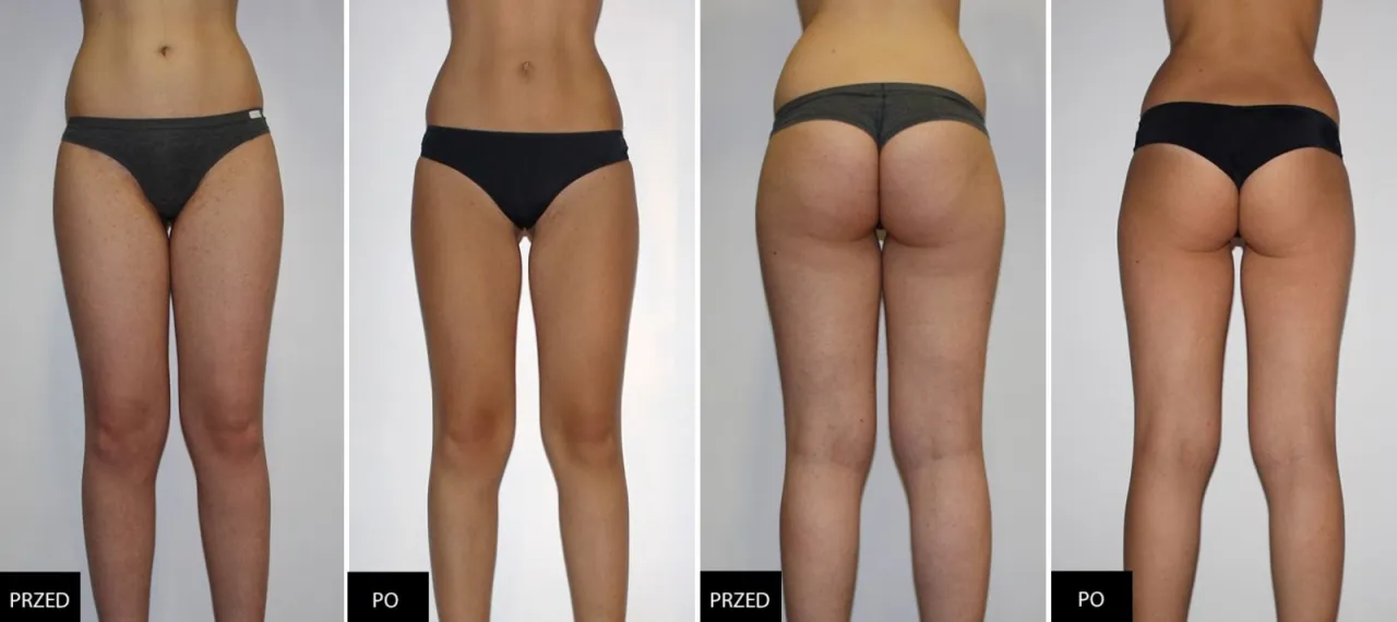 Endermologia Alliance LPG przed i po efekty