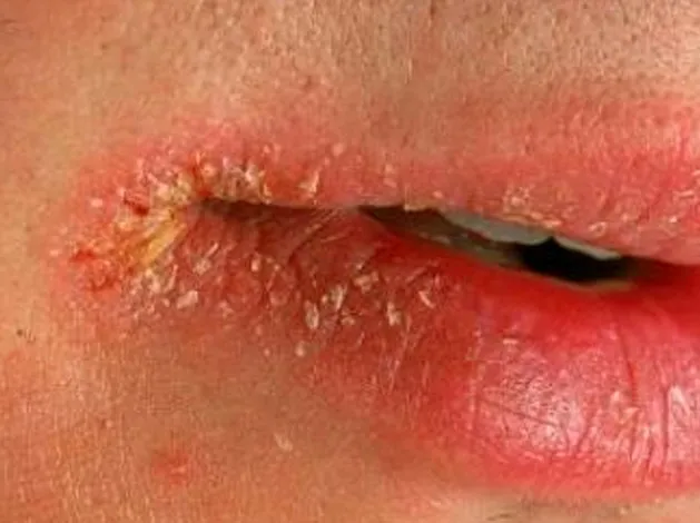 objawy niedoboru witaminy b skóra zajady